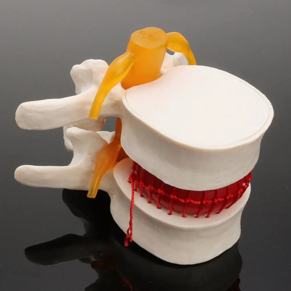 White PVC anatomical model of a herniated lumbar intervertebral disc for medical demonstration.