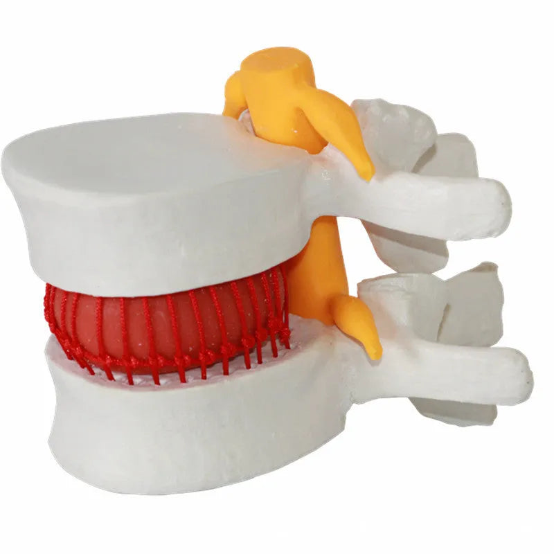 White PVC anatomical model of a herniated lumbar intervertebral disc for medical demonstration.