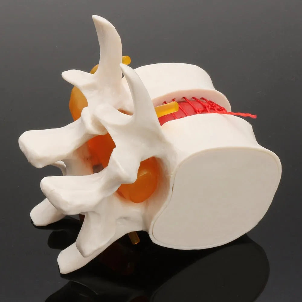 White PVC anatomical model of a herniated lumbar intervertebral disc for medical demonstration.