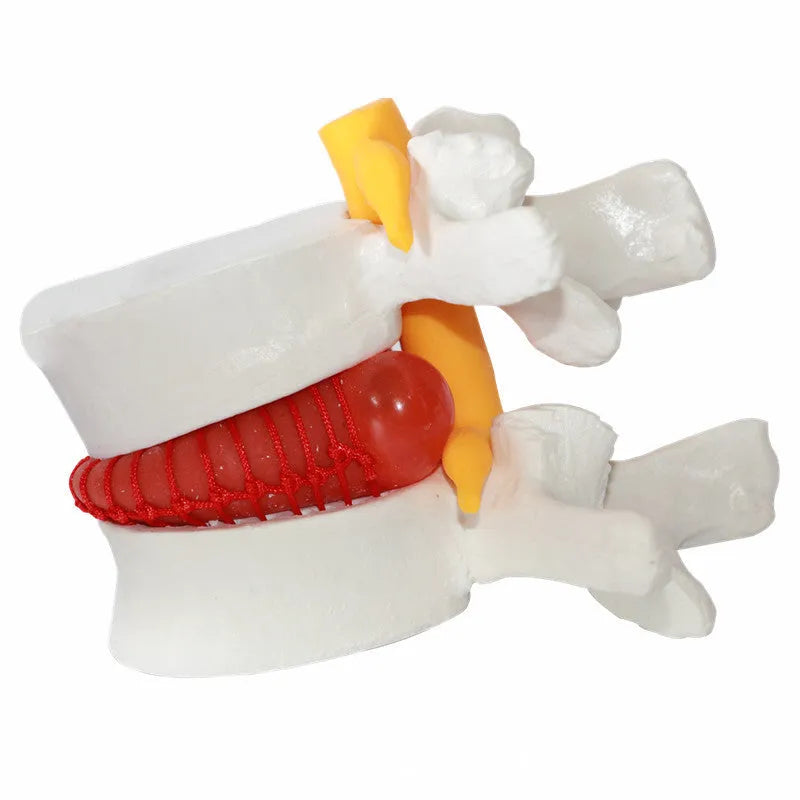 White PVC anatomical model of a herniated lumbar intervertebral disc for medical demonstration.