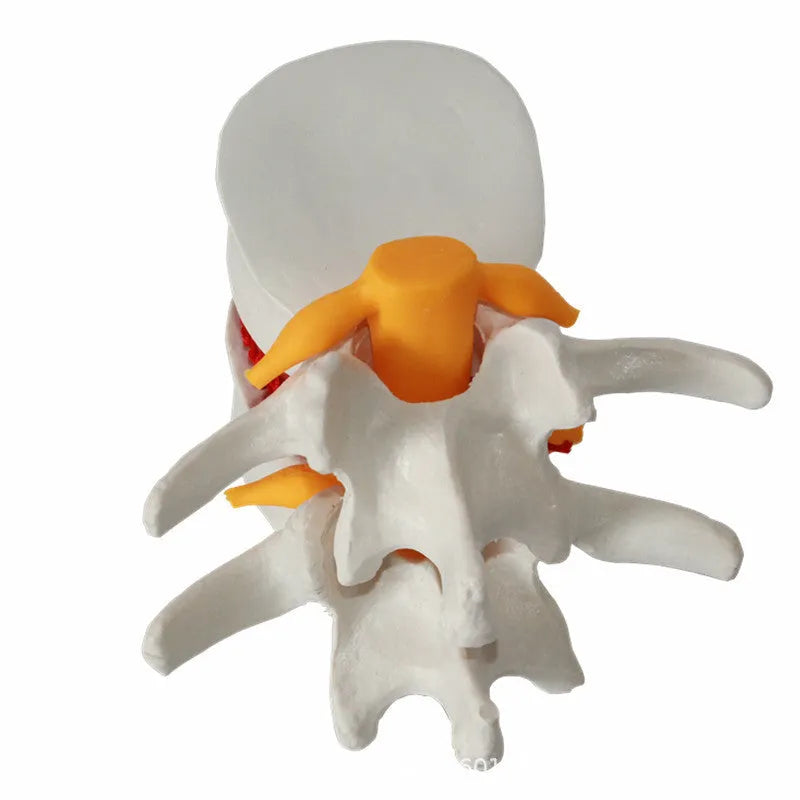 White PVC anatomical model of a herniated lumbar intervertebral disc for medical demonstration.