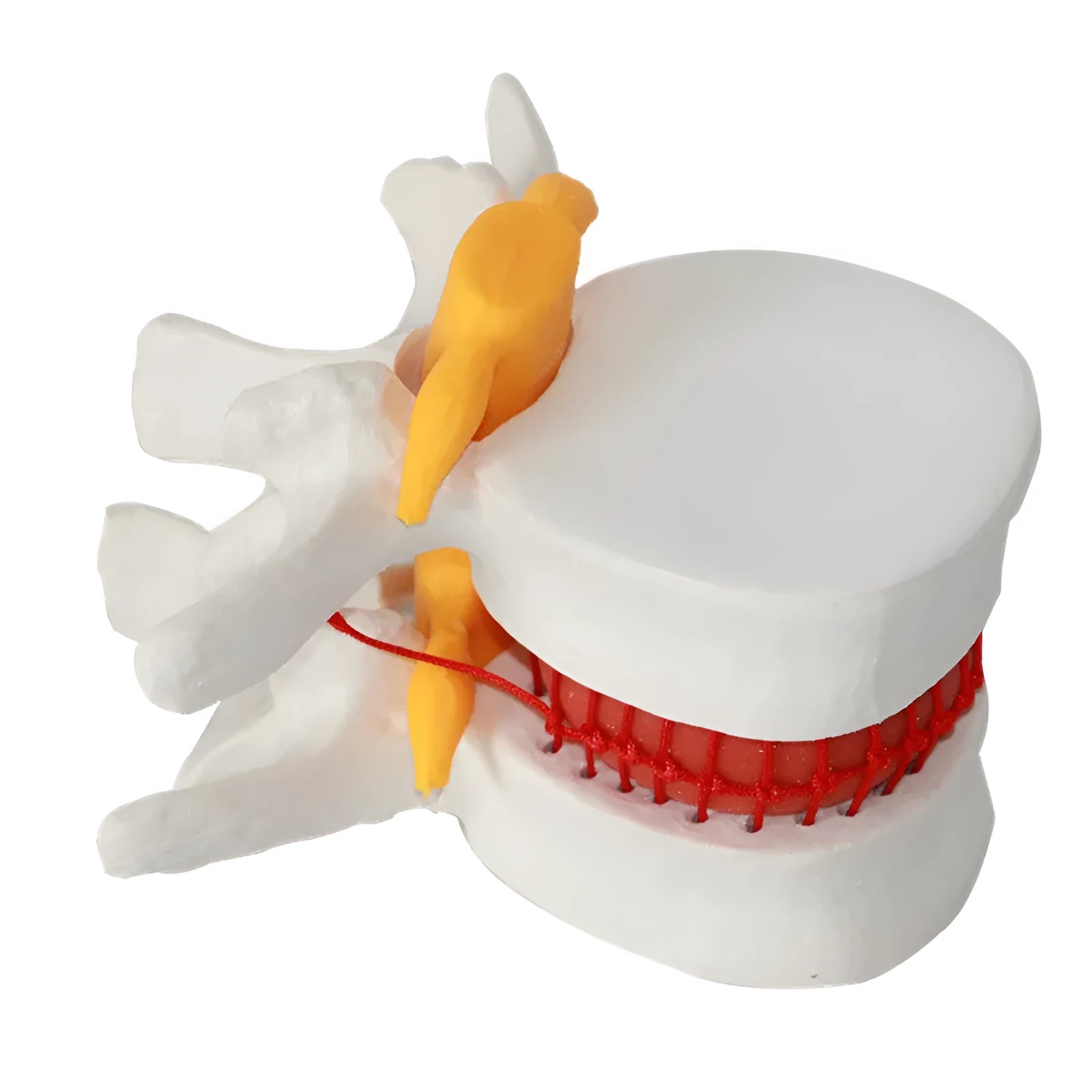 White PVC anatomical model of a herniated lumbar intervertebral disc for medical demonstration.