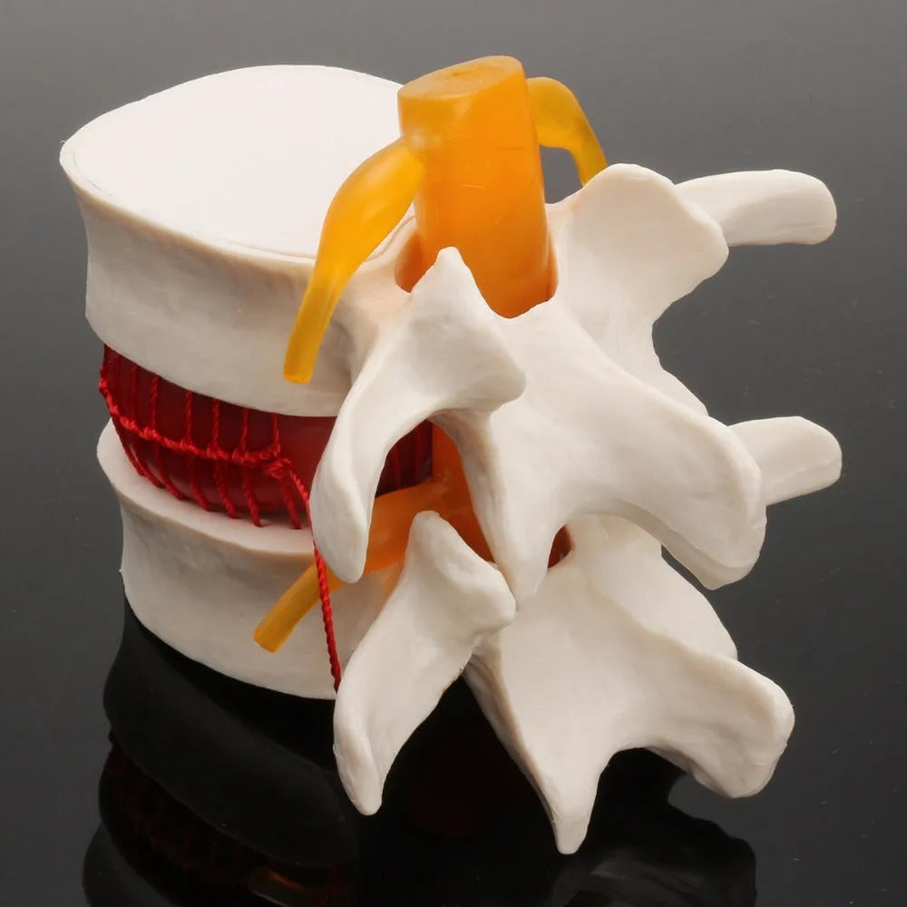White PVC anatomical model of a herniated lumbar intervertebral disc for medical demonstration.