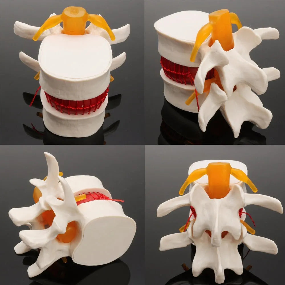White PVC anatomical model of a herniated lumbar intervertebral disc for medical demonstration.