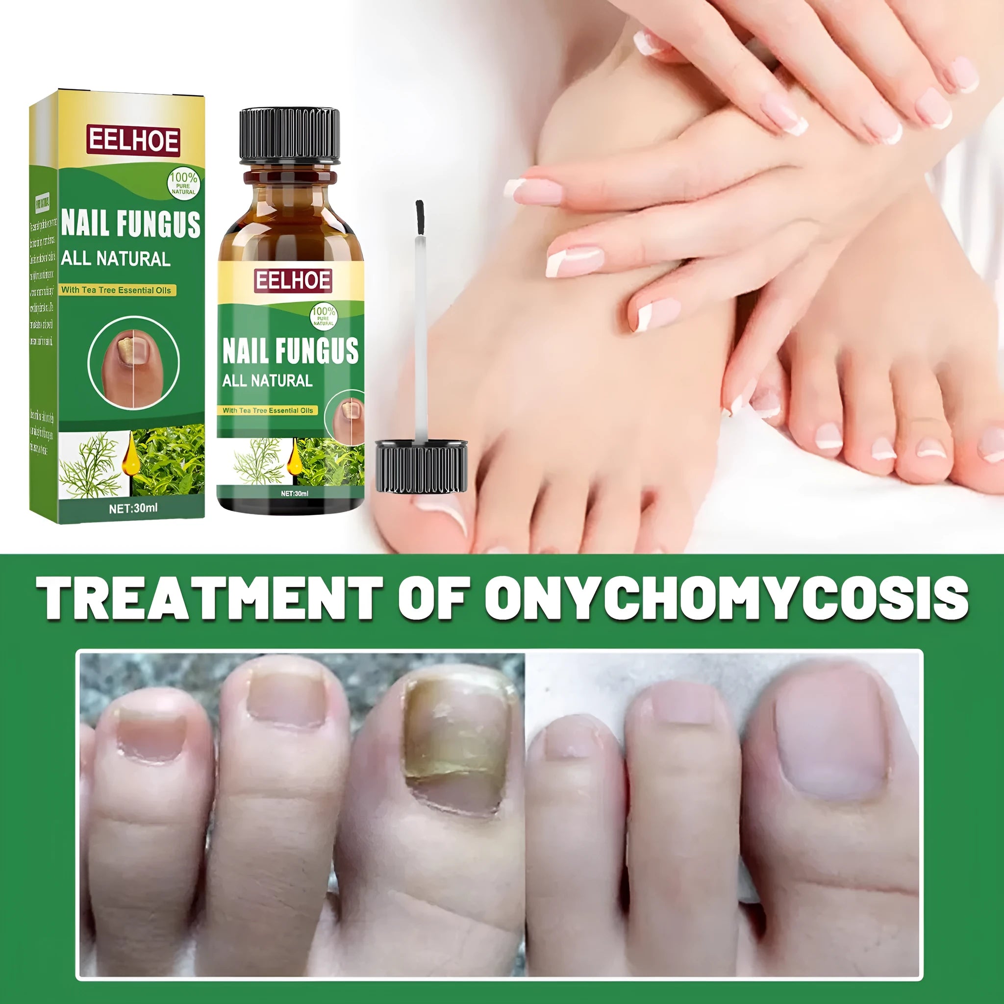 30ml bottle of tea tree oil nail repair liquid with dropper for thickened brittle nails