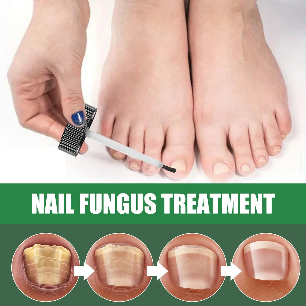 30ml bottle of tea tree oil nail repair liquid with dropper for thickened brittle nails