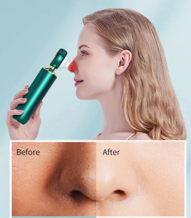 Portable visual blackhead meter with convex lens, three suction tips, and LED light in green colour