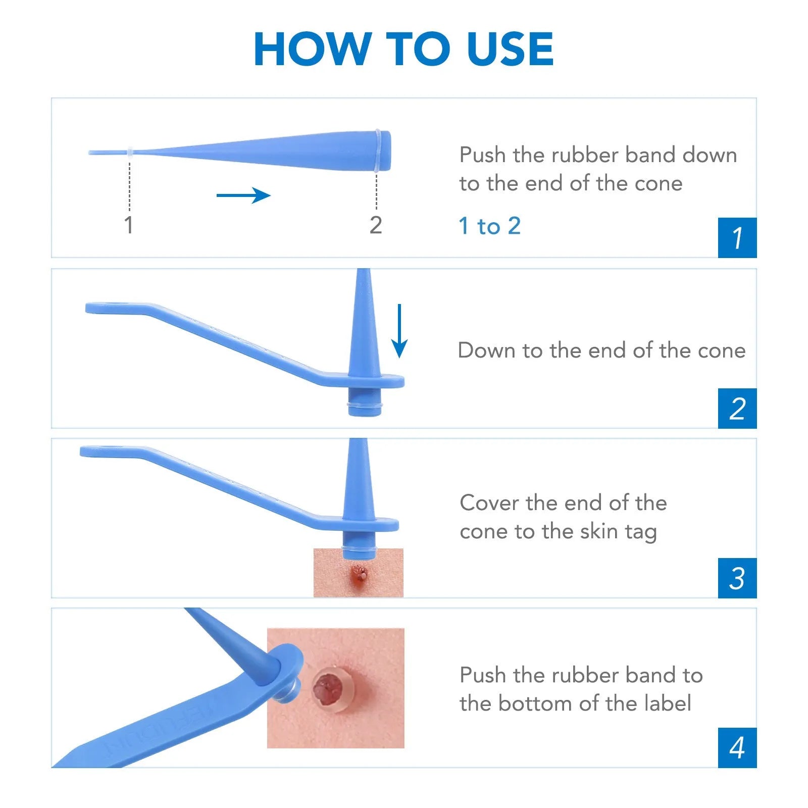 SEFUDUN Simple Wart Removal Tool in blue, green, and orange for at-home mole and skin tag removal